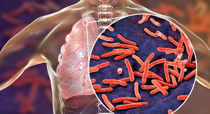Туберкулез менен ооруган адам орозо кармайбы?